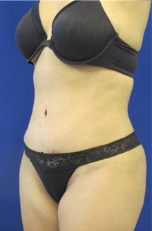 Tummy Tuck After Photo by Munique Maia, MD; Tysons Corner, VA - Case 48939