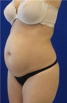 Tummy Tuck Before Photo by Munique Maia, MD; Tysons Corner, VA - Case 48939