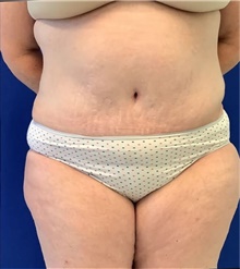 Tummy Tuck After Photo by Munique Maia, MD; Tysons Corner, VA - Case 48941