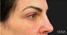 Eyelid Surgery After Photo by Munique Maia, MD; Tysons Corner, VA - Case 48944