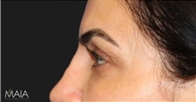 Eyelid Surgery After Photo by Munique Maia, MD; Tysons Corner, VA - Case 48944