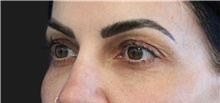 Eyelid Surgery Before Photo by Munique Maia, MD; Tysons Corner, VA - Case 48944