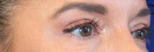 Eyelid Surgery After Photo by Munique Maia, MD; Tysons Corner, VA - Case 48947