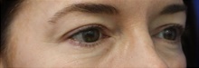 Eyelid Surgery Before Photo by Munique Maia, MD; Tysons Corner, VA - Case 48947
