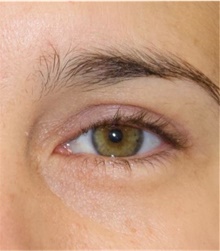 Eyelid Surgery After Photo by Munique Maia, MD; Tysons Corner, VA - Case 48948