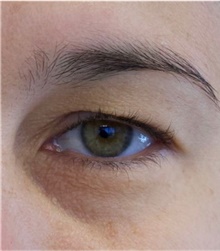 Eyelid Surgery Before Photo by Munique Maia, MD; Tysons Corner, VA - Case 48948