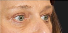 Eyelid Surgery After Photo by Munique Maia, MD; Tysons Corner, VA - Case 48949