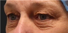Eyelid Surgery Before Photo by Munique Maia, MD; Tysons Corner, VA - Case 48949