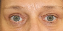 Eyelid Surgery After Photo by Munique Maia, MD; Tysons Corner, VA - Case 48949