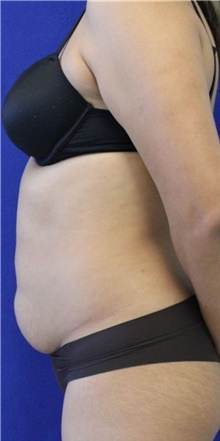Liposuction Before Photo by Munique Maia, MD; Tysons Corner, VA - Case 48950