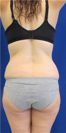 Liposuction Before Photo by Munique Maia, MD; Tysons Corner, VA - Case 48951