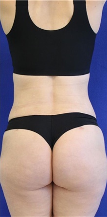 Liposuction After Photo by Munique Maia, MD; Tysons Corner, VA - Case 48951