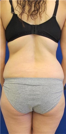 Liposuction Before Photo by Munique Maia, MD; Tysons Corner, VA - Case 48951
