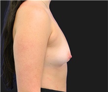 Breast Augmentation Before Photo by Munique Maia, MD; Tysons Corner, VA - Case 48953