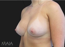 Breast Augmentation After Photo by Munique Maia, MD; Tysons Corner, VA - Case 48953