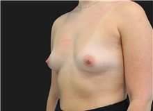 Breast Augmentation Before Photo by Munique Maia, MD; Tysons Corner, VA - Case 48953