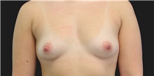 Breast Augmentation Before Photo by Munique Maia, MD; Tysons Corner, VA - Case 48953