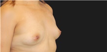 Breast Augmentation Before Photo by Munique Maia, MD; Tysons Corner, VA - Case 48954