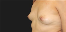 Breast Augmentation Before Photo by Munique Maia, MD; Tysons Corner, VA - Case 48954