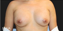 Breast Augmentation After Photo by Munique Maia, MD; Tysons Corner, VA - Case 48954