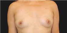 Breast Augmentation Before Photo by Munique Maia, MD; Tysons Corner, VA - Case 48954