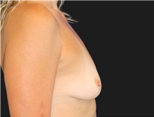 Breast Augmentation Before Photo by Munique Maia, MD; Tysons Corner, VA - Case 48955