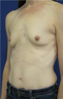 Breast Augmentation Before Photo by Munique Maia, MD; Tysons Corner, VA - Case 48958