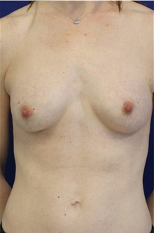 Breast Augmentation After Photo by Munique Maia, MD; Tysons Corner, VA - Case 48958