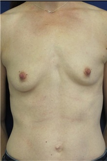 Breast Augmentation Before Photo by Munique Maia, MD; Tysons Corner, VA - Case 48958