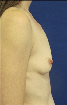 Breast Augmentation Before Photo by Munique Maia, MD; Tysons Corner, VA - Case 48958