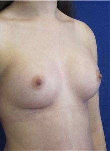 Breast Augmentation After Photo by Munique Maia, MD; Tysons Corner, VA - Case 48960