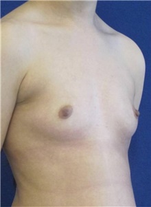 Breast Augmentation Before Photo by Munique Maia, MD; Tysons Corner, VA - Case 48960