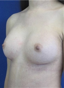 Breast Augmentation After Photo by Munique Maia, MD; Tysons Corner, VA - Case 48960