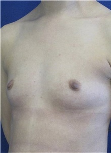 Breast Augmentation Before Photo by Munique Maia, MD; Tysons Corner, VA - Case 48960