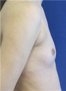 Breast Augmentation Before Photo by Munique Maia, MD; Tysons Corner, VA - Case 48960