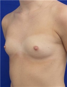 Breast Augmentation Before Photo by Munique Maia, MD; Tysons Corner, VA - Case 48962