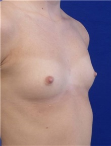 Breast Augmentation Before Photo by Munique Maia, MD; Tysons Corner, VA - Case 48962