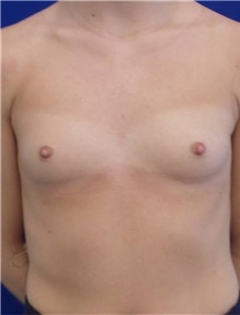 Breast Augmentation Before Photo by Munique Maia, MD; Tysons Corner, VA - Case 48962