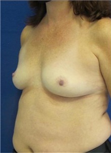 Breast Augmentation Before Photo by Munique Maia, MD; Tysons Corner, VA - Case 48963