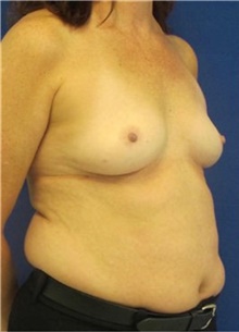 Breast Augmentation Before Photo by Munique Maia, MD; Tysons Corner, VA - Case 48963