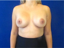 Breast Augmentation After Photo by Munique Maia, MD; Tysons Corner, VA - Case 48964