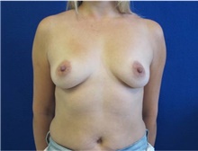 Breast Augmentation Before Photo by Munique Maia, MD; Tysons Corner, VA - Case 48964