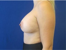 Breast Augmentation After Photo by Munique Maia, MD; Tysons Corner, VA - Case 48964