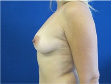 Breast Augmentation Before Photo by Munique Maia, MD; Tysons Corner, VA - Case 48964