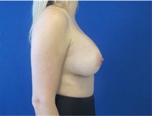 Breast Augmentation After Photo by Munique Maia, MD; Tysons Corner, VA - Case 48964