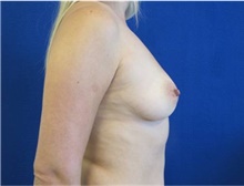 Breast Augmentation Before Photo by Munique Maia, MD; Tysons Corner, VA - Case 48964