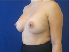 Breast Augmentation After Photo by Munique Maia, MD; Tysons Corner, VA - Case 48964