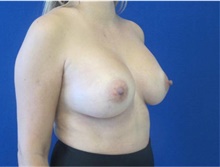 Breast Augmentation After Photo by Munique Maia, MD; Tysons Corner, VA - Case 48964