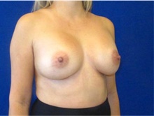 Breast Augmentation After Photo by Munique Maia, MD; Tysons Corner, VA - Case 48964