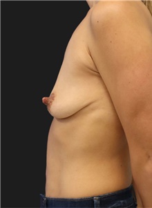 Breast Augmentation Before Photo by Munique Maia, MD; Tysons Corner, VA - Case 48966